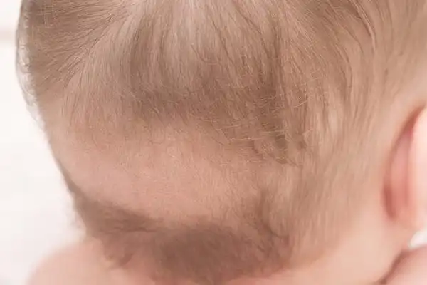 علل و راه‌های مقابله با ریزش مو در نوزادان و کودکان